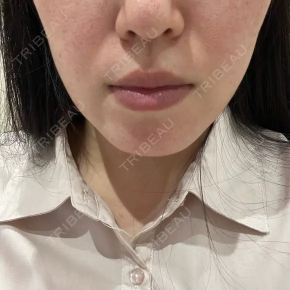 光治療（フォトフェイシャルなど） / ピーリング（ハリ・ツヤ） トラスト美容クリニック 銀座院 BEFORE メイン用