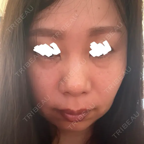 下まぶたたるみ取り アネシス美容クリニック BEFORE メイン用