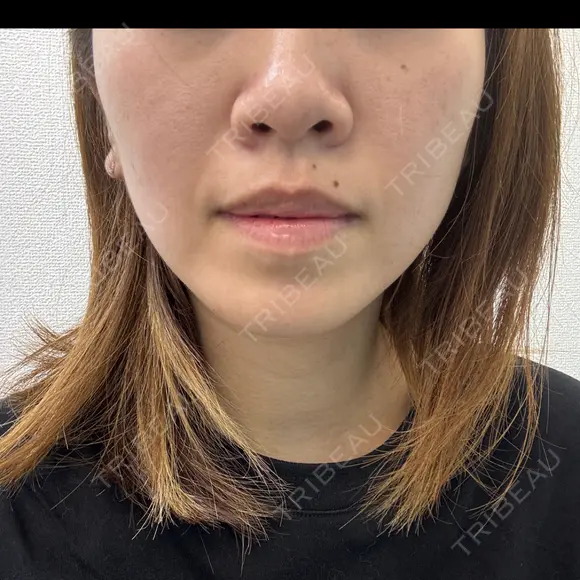 ベビーコラーゲン / RF（高周波）たるみ治療 TUNE CLINIC【チューンクリニック】 BEFORE メイン用