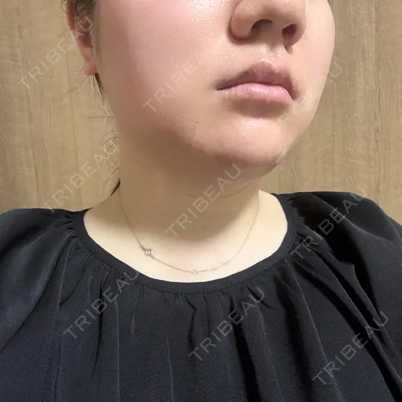 脂肪溶解注射（顔） / ニキビ治療 SUI CLINIC BEFORE メイン用