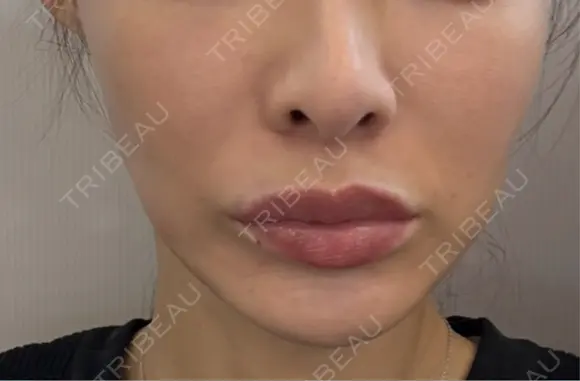 肌ヒアルロン酸注入（たるみ・シワ改善） PRISM Beauty Clinic 町田院 BEFORE メイン用