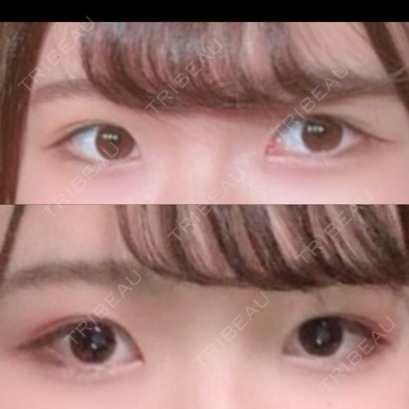 ヒアルロン酸注入（涙袋） / ボトックス（エラ・小顔） / ヒアルロン酸注入（唇） DMTC美容皮膚科 大宮院 BEFORE メイン用