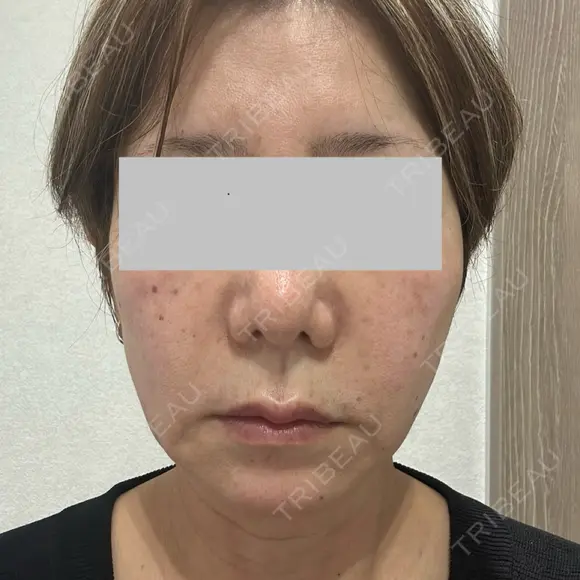 RF（高周波）たるみ治療 Wi Clinic （ウィ クリニック）心斎橋院 BEFORE メイン用