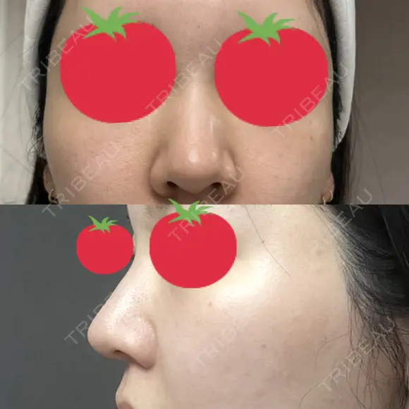 ヒアルロン酸注入（鼻） A CLINIC（エークリニック） 横浜院 BEFORE メイン用