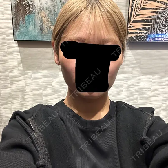 ボトックス（エラ・小顔） 札幌TAクリニック BEFORE メイン用