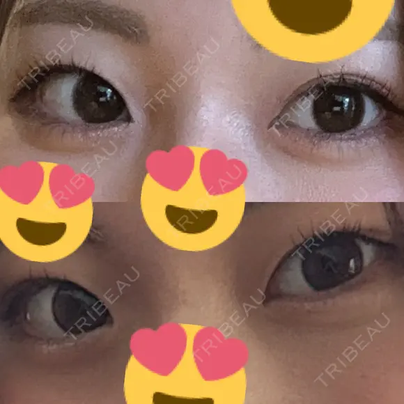 二重埋没 / 目頭切開 EMMO FACE CLINIC 東京三田院 BEFORE メイン用