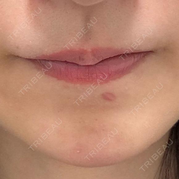 ヒアルロン酸注入（唇） NARU Beauty Clinic 【ナルクリ】 BEFORE メイン用