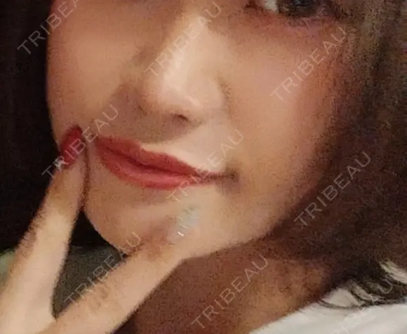 ヒアルロン酸注入（鼻） plume clinic BEFORE メイン用