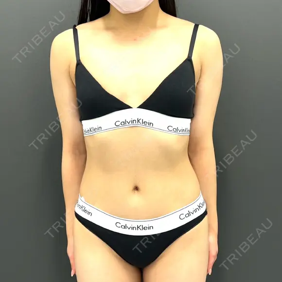 豊胸（シリコンバッグ） plume clinic BEFORE メイン用