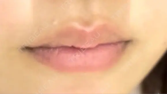 ヒアルロン酸注入（唇） プライベートスキンクリニック 梅田本院 BEFORE メイン用