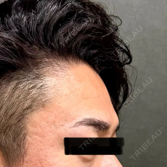 ヒアルロン酸注入（額） / ボトックス（眉間） / ボトックス（目尻） / ボトックス（額） ネビュラクリニック 京都院 BEFORE メイン用