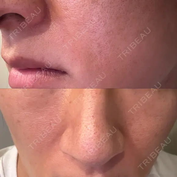 ルメッカ / ミラノリピール ON-CLINIC Beauty BEFORE メイン用