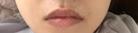 ヒアルロン酸注入（唇） 目白ホワイトクリニック BEFORE メイン用