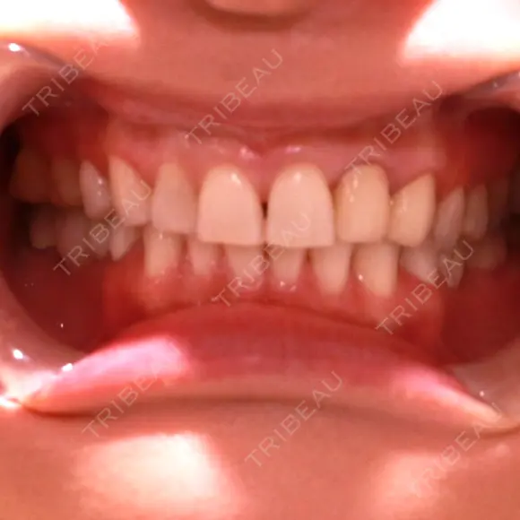 矯正（ワイヤー） / セラミック 東京美容外科 赤坂院 BEFORE メイン用