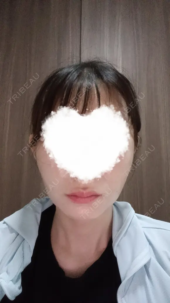 ボトックス（口角） DMTC CLINIC 日本橋院 BEFORE メイン用