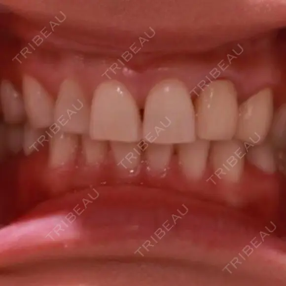 矯正（ワイヤー） / セラミック 東京美容外科 赤坂院 BEFORE メイン用