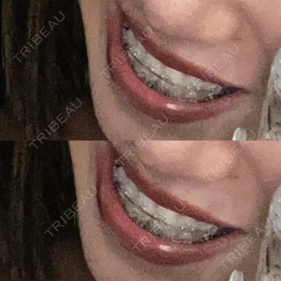 矯正（ワイヤー） Shiny Teeth Clinic 【シャイニー ティース クリニック】 BEFORE メイン用