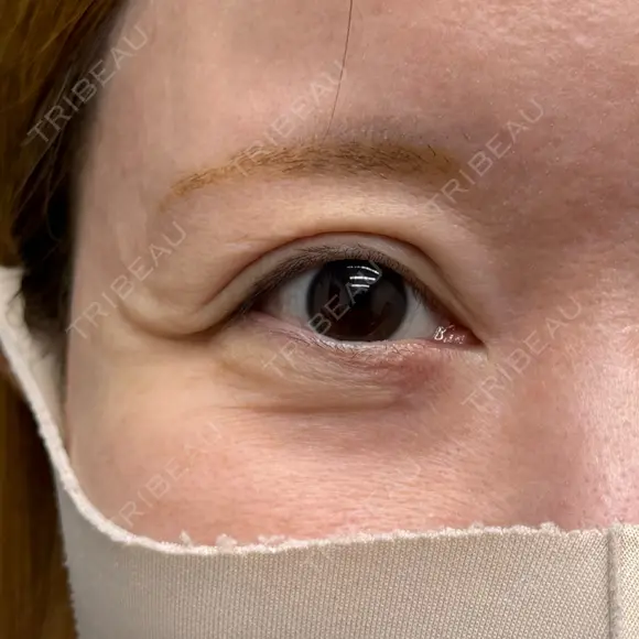 下まぶたたるみ取り / その他（目元） ネビュラクリニック 京都院 BEFORE メイン用