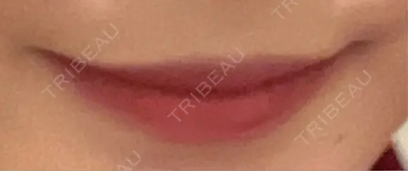 ヒアルロン酸注入（唇） 目白ホワイトクリニック BEFORE メイン用