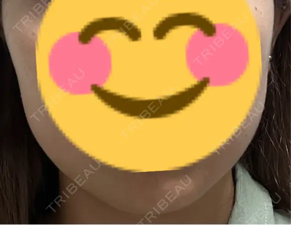 ボトックス（エラ・小顔） 共立美容外科 梅田院 BEFORE メイン用