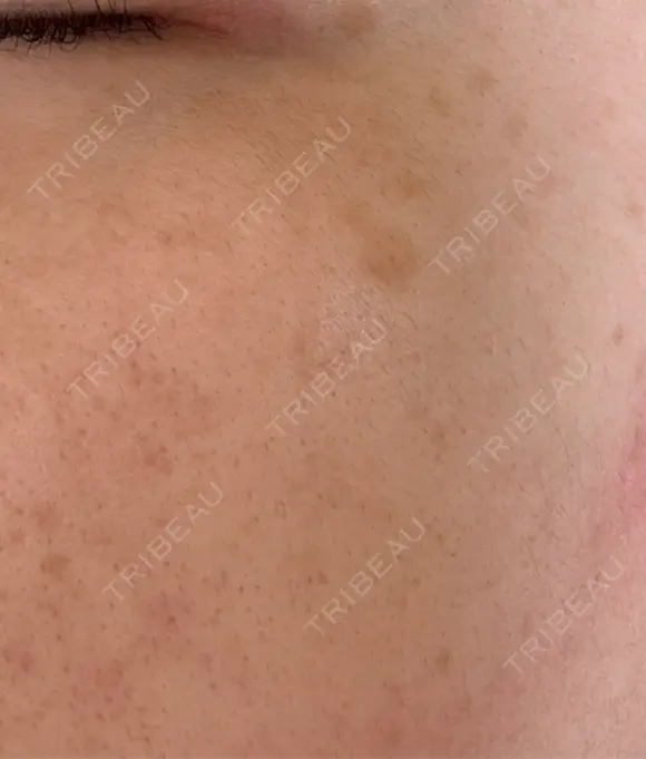 ルメッカ Clinic K Blossom BEFORE メイン用