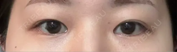 二重埋没 eクリニック 横浜みなとみらい院 BEFORE メイン用