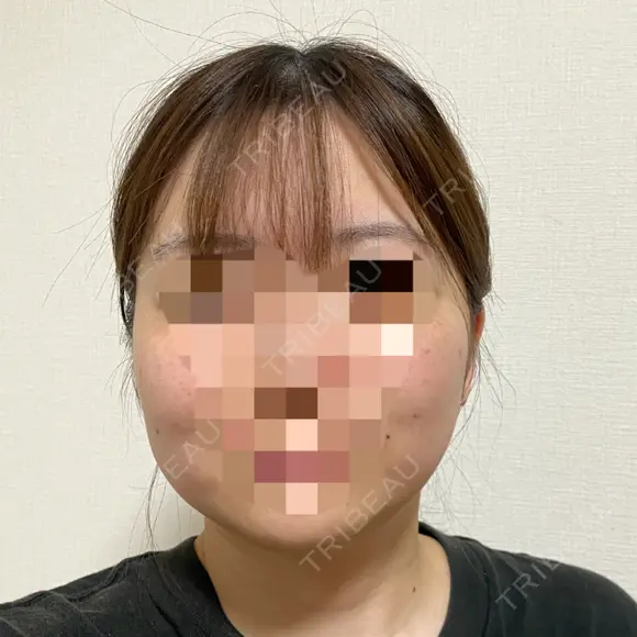 糸リフト / 脂肪吸引（顔） / ジョールファット除去 GRACIA clinic 【グラシアクリニック】 BEFORE メイン用