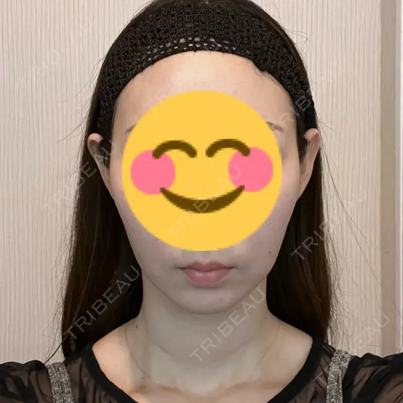 糸リフト 藤・ナチュレ美容クリニック 銀座院 BEFORE メイン用