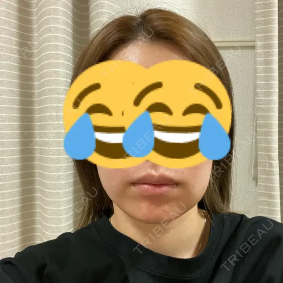 ボトックス（あご） / ボトックス（エラ・小顔） / 脂肪溶解注射（顔） / ボトックス（口角） / ボトックス（首） M'sクリニック【エムズクリニック】 BEFORE メイン用
