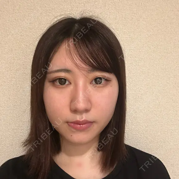 糸リフト / バッカルファット除去 / 脂肪吸引（顔） / メーラーファット除去 / ジョールファット除去 / ボトックス（あご） First Clinic BEFORE メイン用