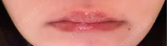 ヒアルロン酸注入（唇） 目白ホワイトクリニック BEFORE メイン用