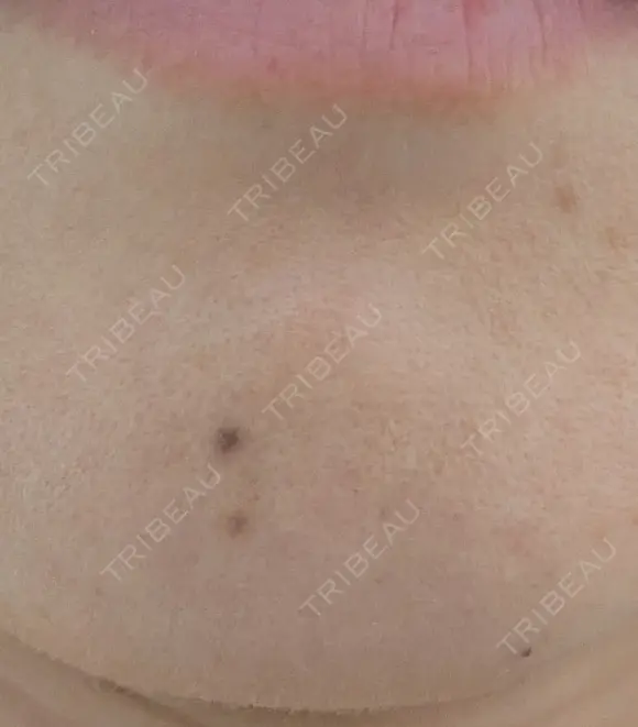 ほくろ・いぼ除去レーザー（肌） プライベートスキンクリニック 梅田本院 BEFORE メイン用