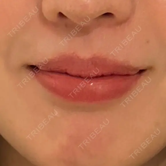 ヒアルロン酸注入（唇） 目白ホワイトクリニック BEFORE メイン用