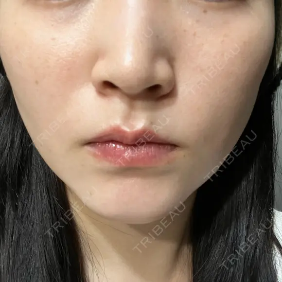 ルメッカ L‘amour clinic Tokyo【ラムールクリニック東京】 BEFORE メイン用