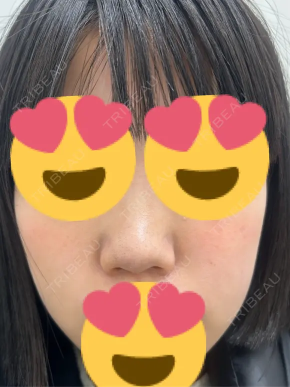 脂肪溶解注射（顔） ゆう美容クリニック BEFORE メイン用