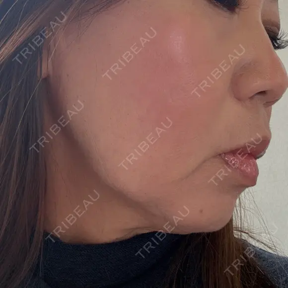 RF（高周波）たるみ治療 Wi Clinic （ウィ クリニック）心斎橋院 BEFORE メイン用