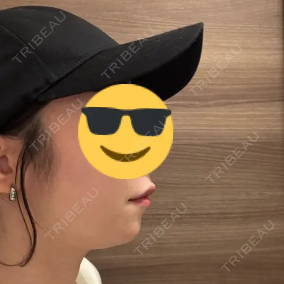 ヒアルロン酸注入（あご） / ボトックス（エラ・小顔） ルラ美容クリニック 千葉院 / ルラスキンクリニック 千葉院 BEFORE メイン用