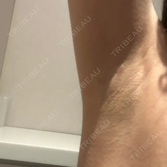 医療脱毛（ワキ） ルラ美容クリニック 新宿院 BEFORE メイン用