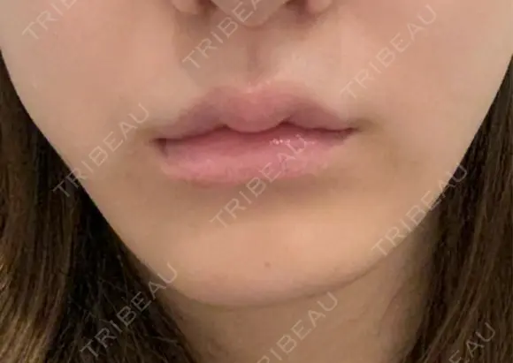 バッカルファット除去 ルラ美容クリニック 札幌本院 BEFORE メイン用