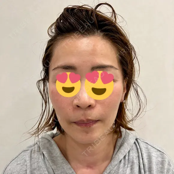 切開リフト GRACY TOKYO CLINIC【グレイシートウキョウクリニック】 BEFORE メイン用