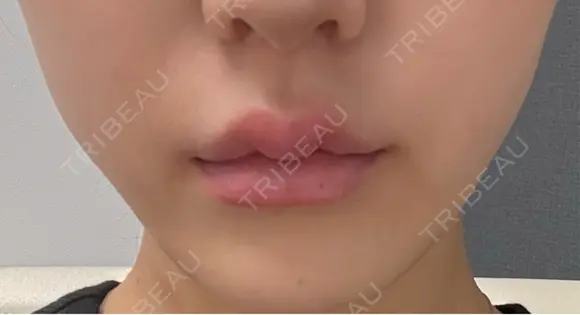 脂肪溶解注射（顔） 札幌美容外科ネビュラクリニック BEFORE メイン用