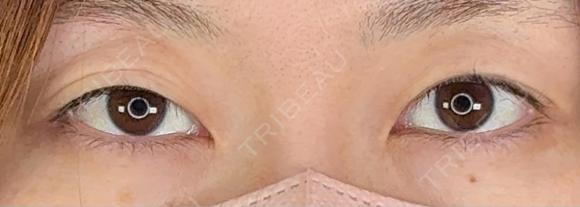 二重埋没 / 上まぶたの脂肪取り アリエル美容クリニック 郡山院 BEFORE メイン用