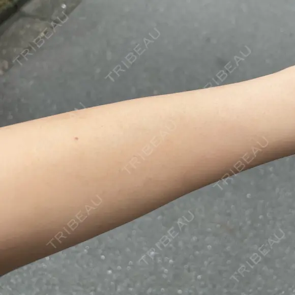 医療脱毛（腕） / 医療脱毛（脚） 表参道メディカルクリニック 新宿院 BEFORE メイン用