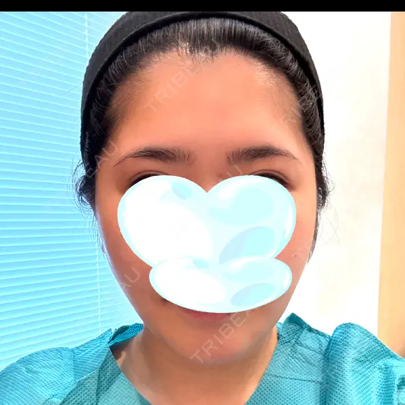 骨切り（あご） / 骨削り（エラ） / 骨削り（頬） リッツ美容外科 東京院 BEFORE メイン用