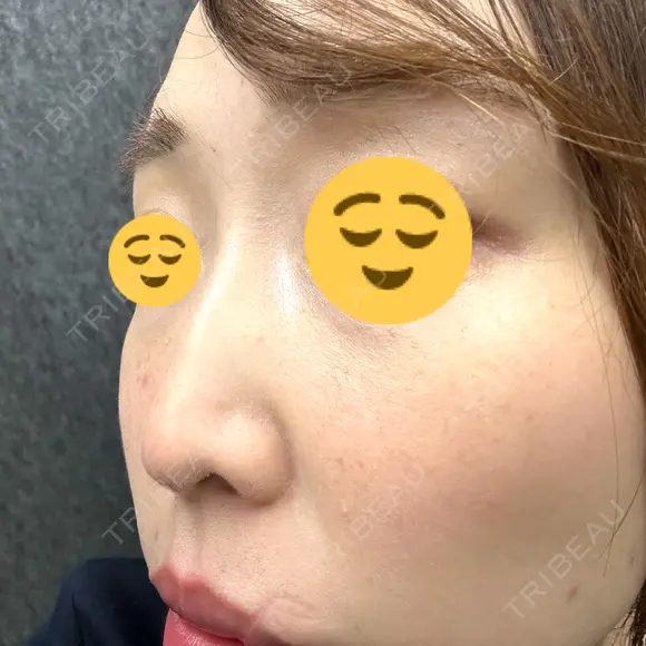 光治療（フォトフェイシャルなど） / ピーリング（ハリ・ツヤ） 東京美容クリニック 表参道本院 BEFORE メイン用