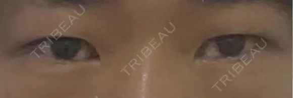 二重埋没 / 目頭切開 eクリニック 横浜みなとみらい院 BEFORE メイン用