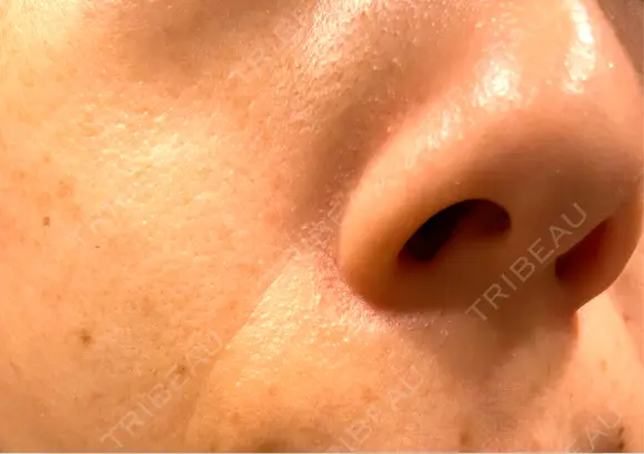 医療脱毛（顔） / 医療脱毛（全身） 共立美容外科 仙台院 BEFORE メイン用