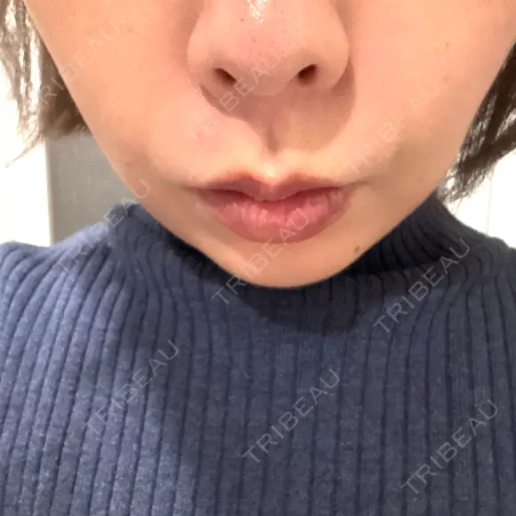 ヒアルロン酸注入（頬） ギャラリークリニック 横浜院 BEFORE メイン用