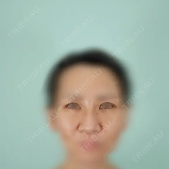 二重埋没 / 隆鼻術 / 鼻尖形成（切開） / 鼻中隔延長（切開） / 小鼻縮小（切開） / クマ治療 / 目尻切開 / 軟骨移植 / 鼻柱下降・鼻唇角形成（猫手術） WOM CLINIC GINZA （ワム クリニック ギンザ） BEFORE メイン用