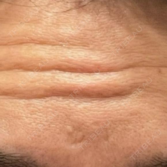 ボトックス（額） FIG CLINIC BEFORE メイン用
